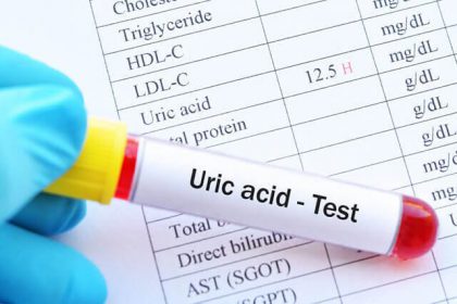 Acid uric cao