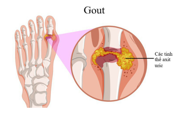 Thông tin cần biết về bệnh gout