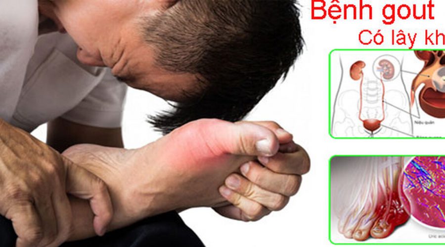 Bệnh gout có lây