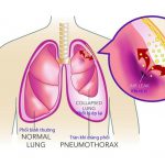 Viêm màng phổi có nguy hiểm không