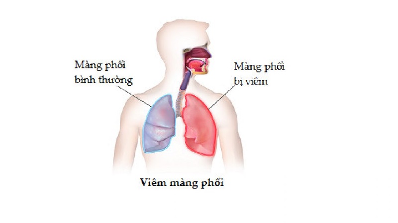 Viêm màng phổi