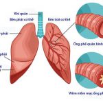 Bệnh viêm phế quản phổi