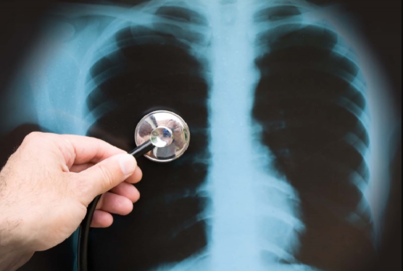 Chẩn đoán viêm phế quản phổi