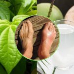 Cách chữa bệnh gout bằng nước dừa và lá trầu không