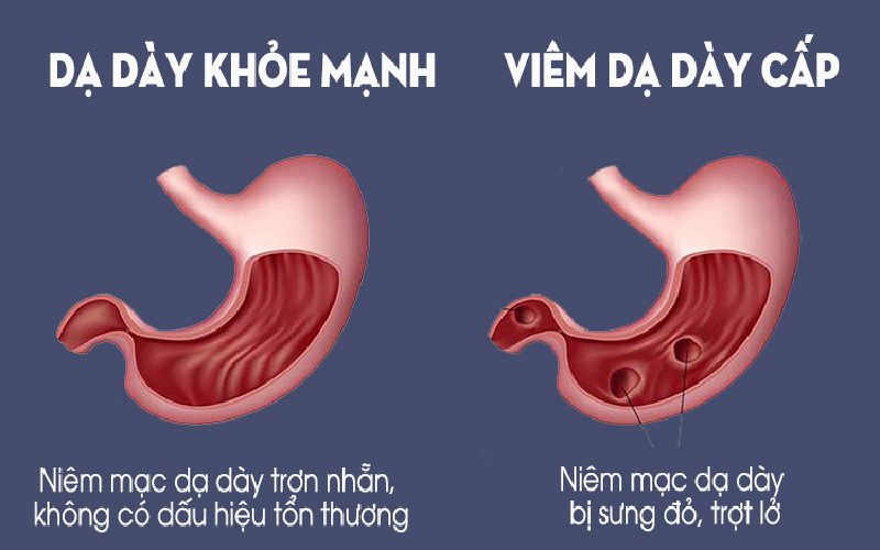 viêm dạ dày