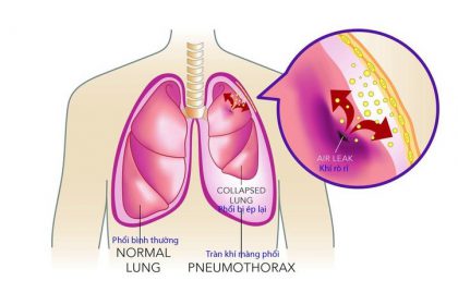 Viêm màng phổi có nguy hiểm không