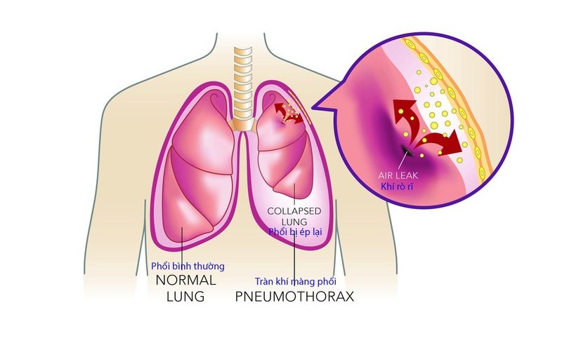 Viêm màng phổi có nguy hiểm không, có lây không? Cách phòng tránh bệnh - 60s